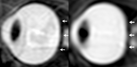 Magnetic-resonance (MR) image of an eye before and after a long-duration space flight. Credit: RSNA